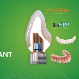 Dental Implant