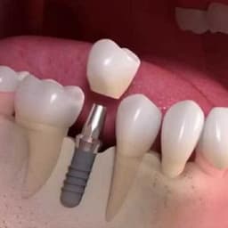 Dental Implants